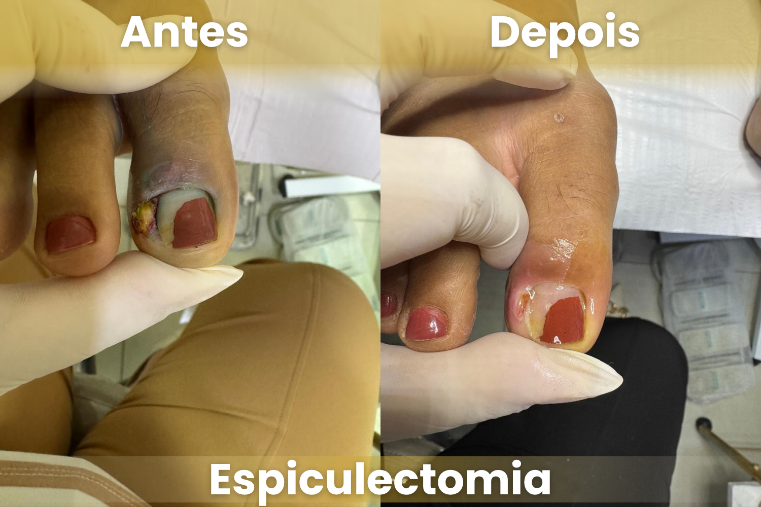 Resultado de procedimento de espiculectomia - tratamento de unha encravada